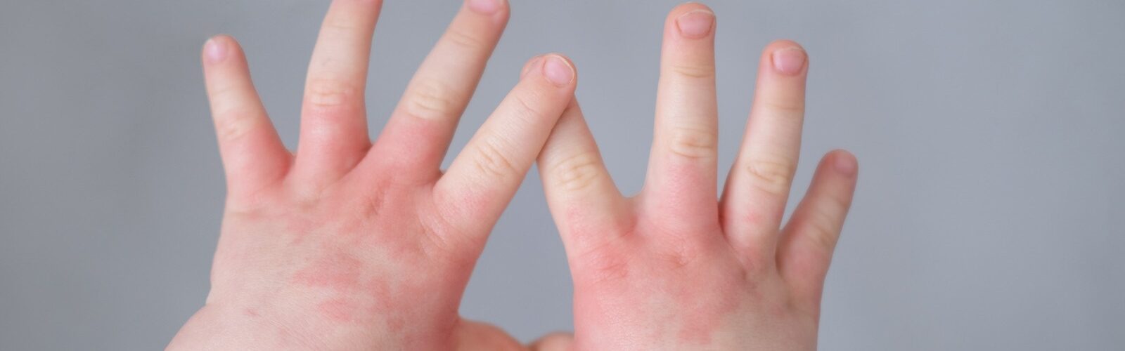 Dermatite atópica atinge 2 em cada 10 crianças com menos de 5 anos; veja recomendações
